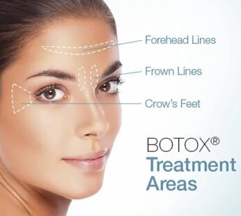 Full-Face Botox