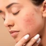 Oncology, Auto‑Immune & Sensitive -Skin Support Facial
