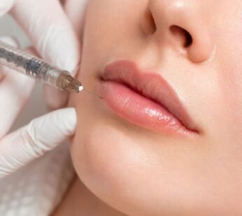 Hyaluronic Fillers (Restylane, Radiesse)
