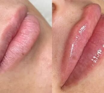 Natural PRP Filler