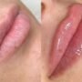 Natural PRP Filler